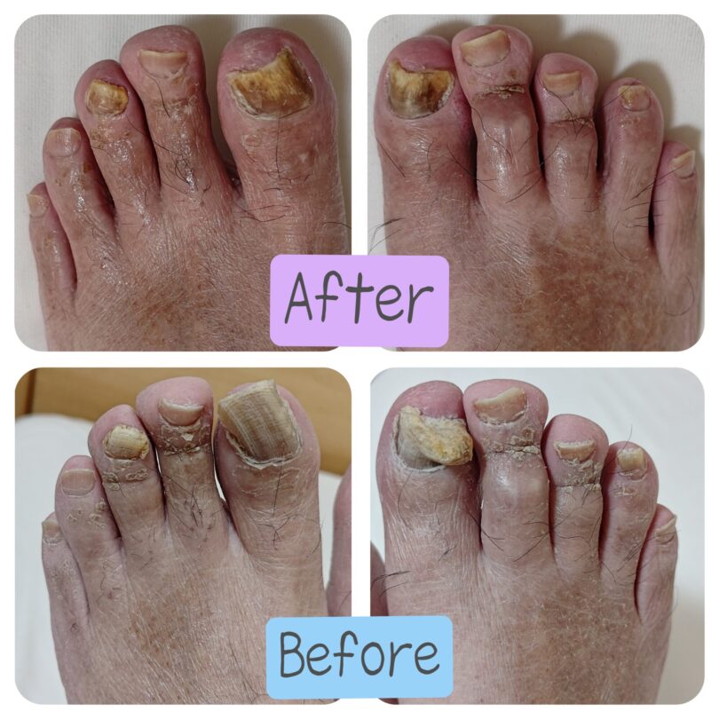 愛知県 高齢者爪切りサービス 肥厚爪ケア ビフォーアフター画像