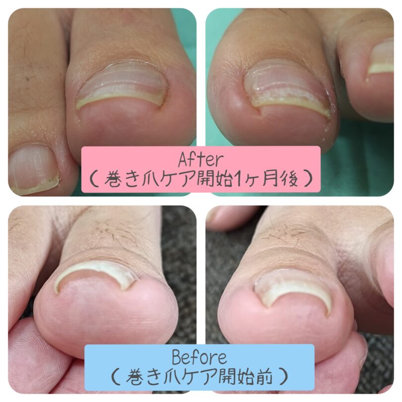 愛知県 巻き爪ケア ビフォーアフター画像
