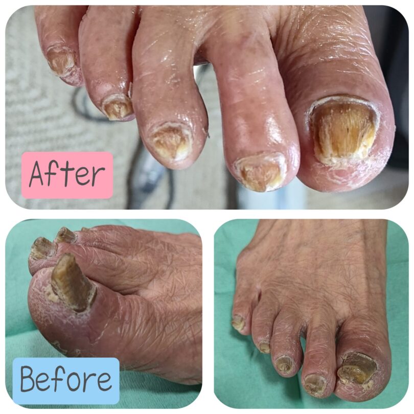愛知県 肥厚爪ケア ビフォーアフター画像