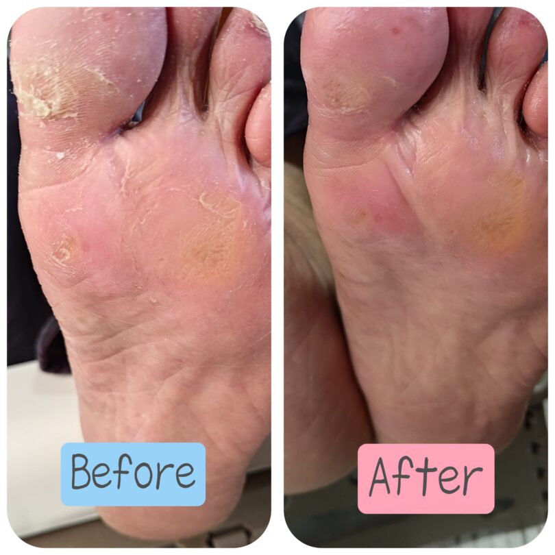 愛知県トラブル爪 ビフォーアフター画像