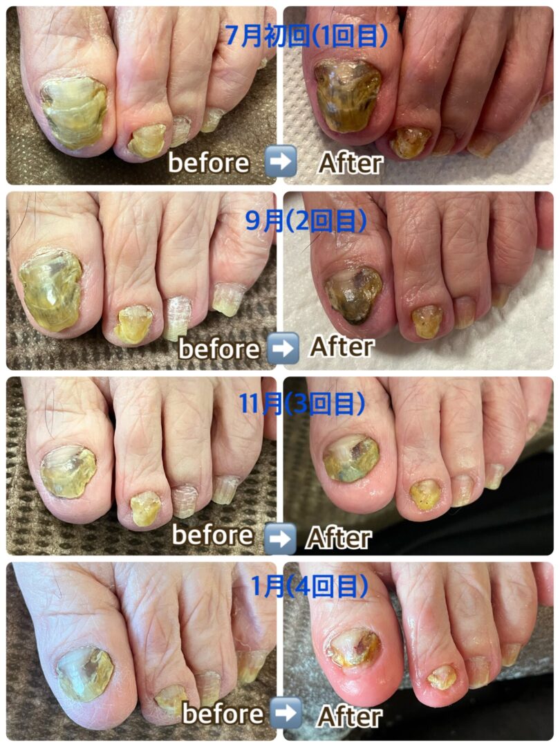 滋賀県 巻き爪 ビフォーアフター写真