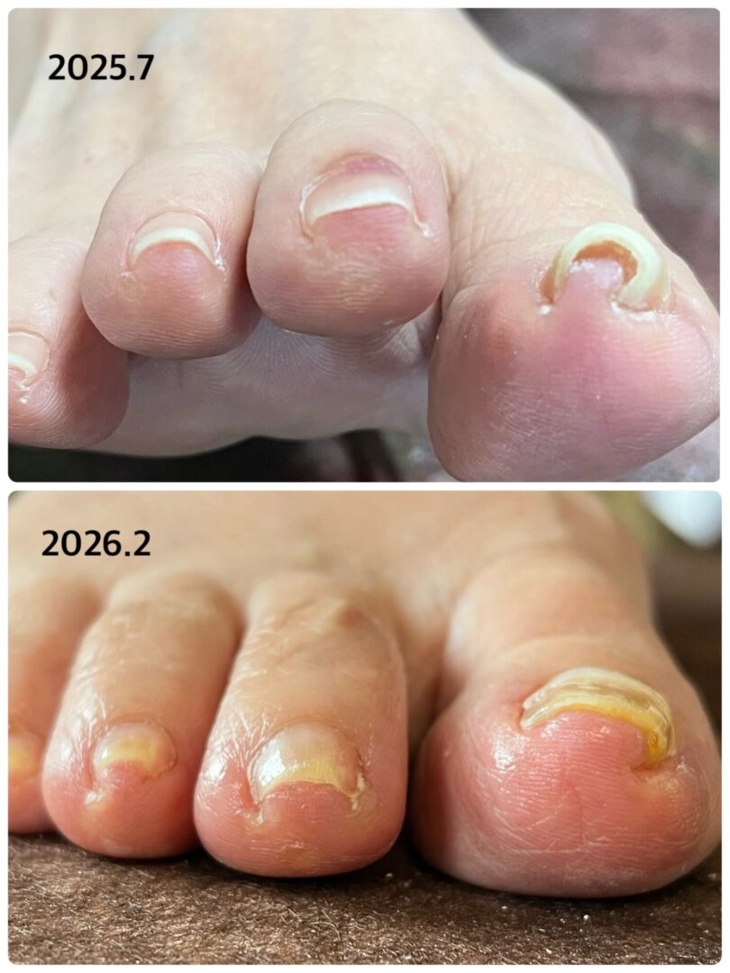 滋賀県 肥厚爪 高齢者爪切りサービス ビフォーアフター写真