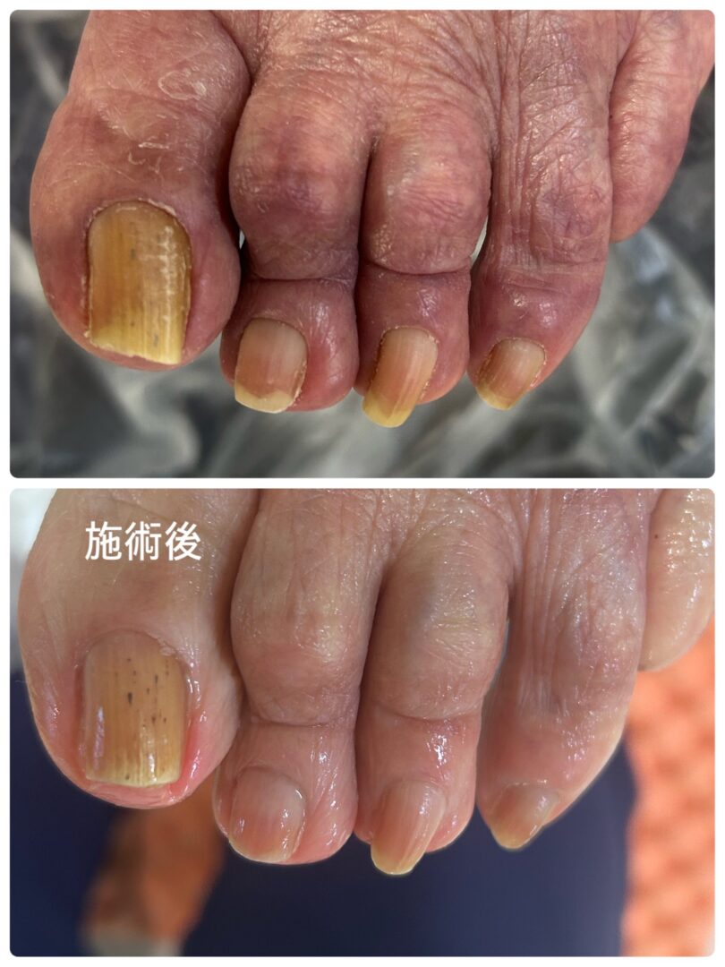 沖縄県那覇市 訪問ネイル ビフォーアフター写真