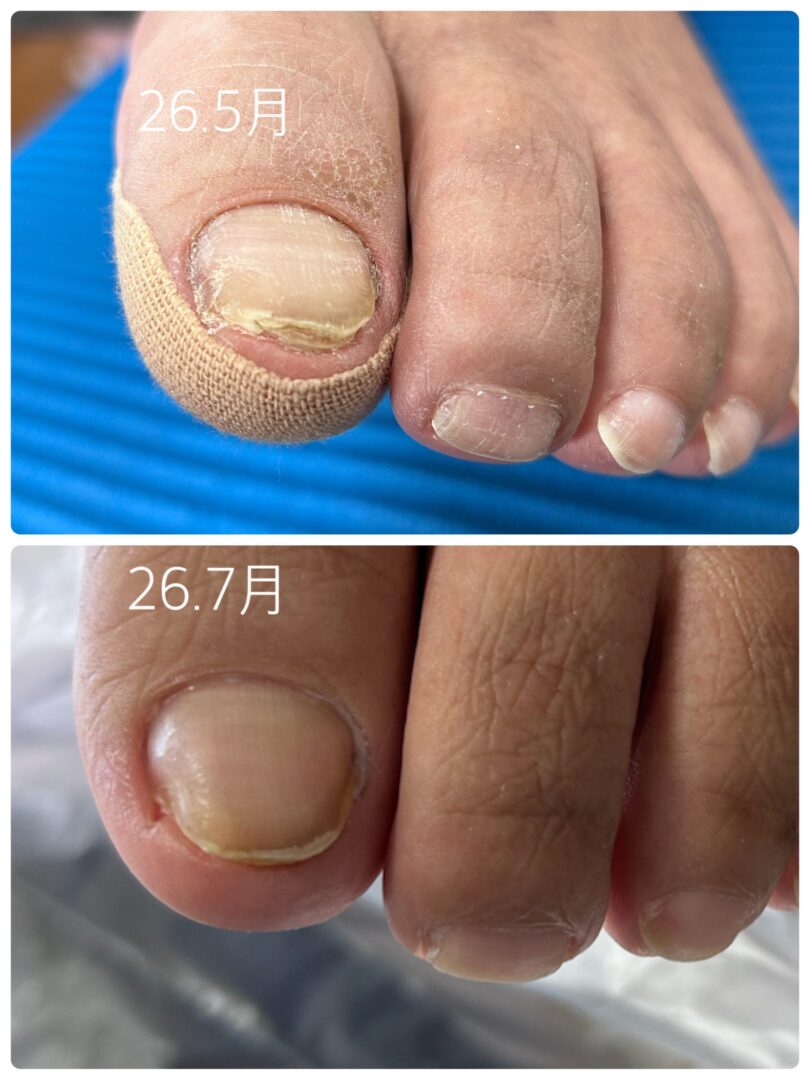 沖縄県那覇市 巻き爪 ビフォーアフター写真
