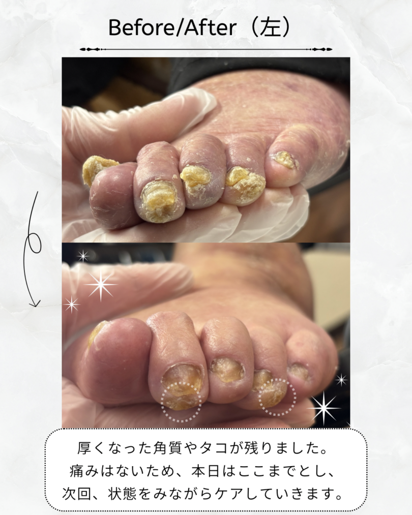 群馬県 甘楽町 肥厚爪ケア