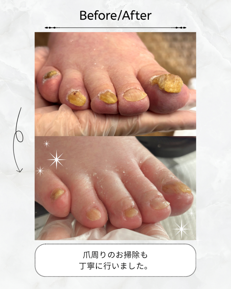 群馬県 前橋市 肥厚爪ケア