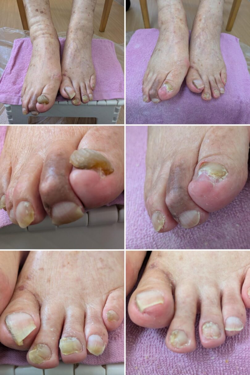 肥厚爪ケア　福岡