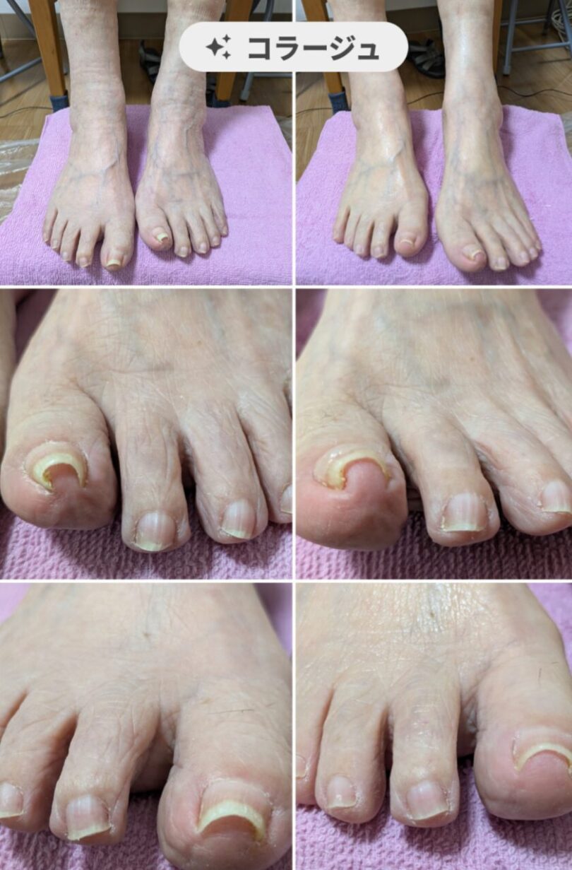 巻き爪ケア　福岡県