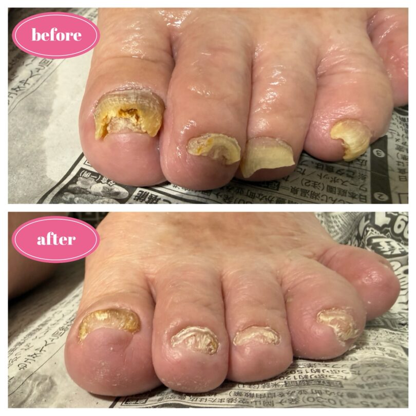 肥厚爪ケア　東京都