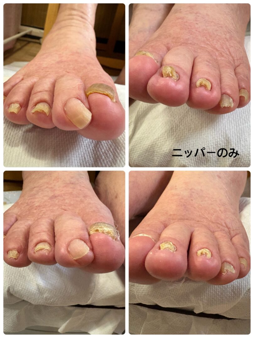 奈良県 肥厚爪ケア ビフォーアフター画像