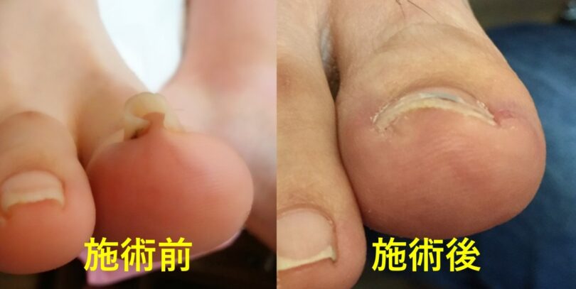 巻き爪ケア　資格