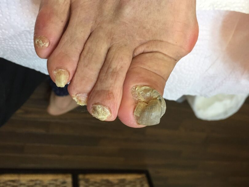 高齢者 爪切りサービス 長崎県