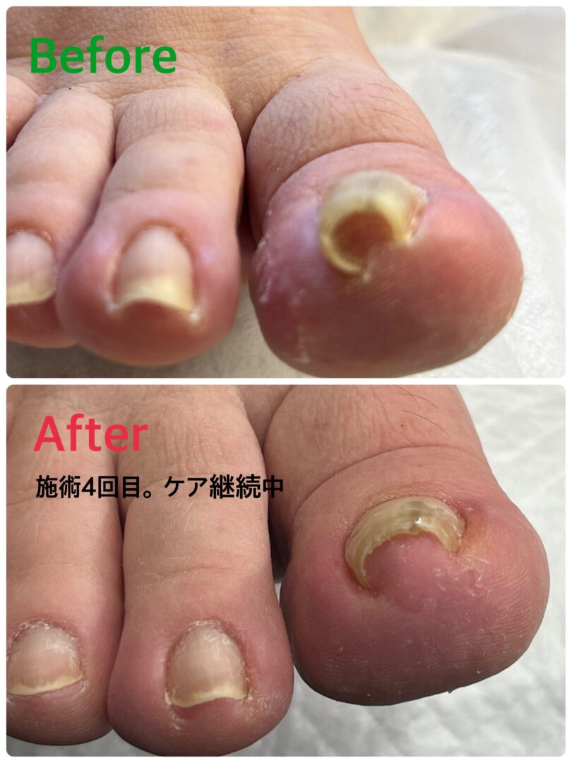 藤沢市 巻き爪ケア