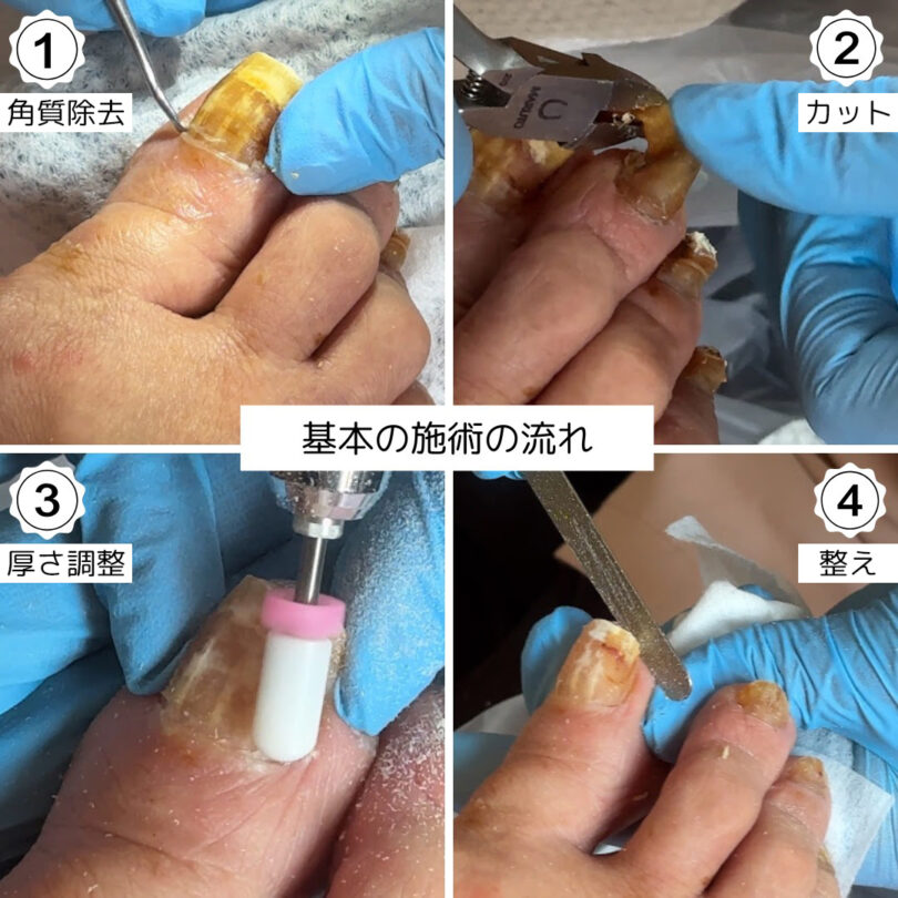 高齢者爪切りサービス 施術例 埼玉県・千葉県・東京